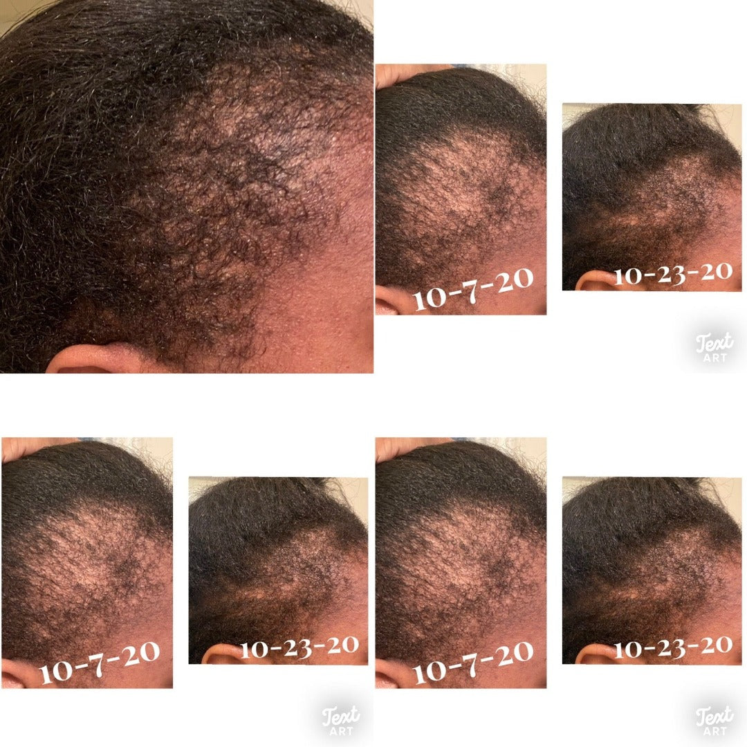 Temple & Hairline Recovery Oil