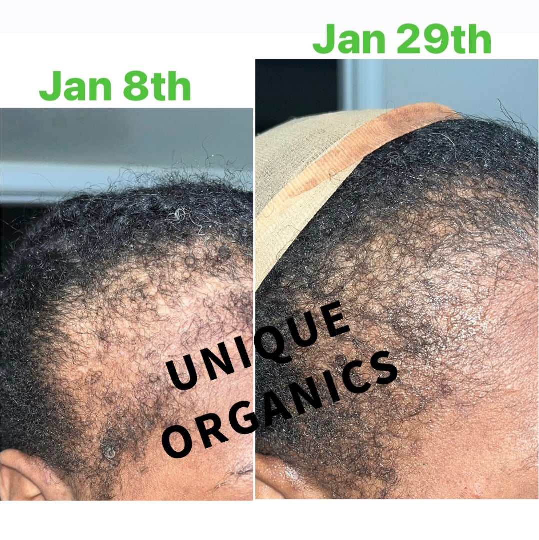 Temple & Hairline Recovery Oil