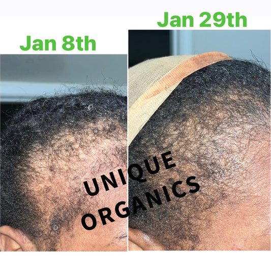 Temple & Hairline Recovery Oil