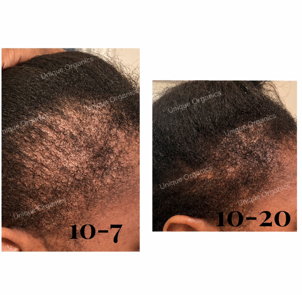 Temple & Hairline Recovery Oil